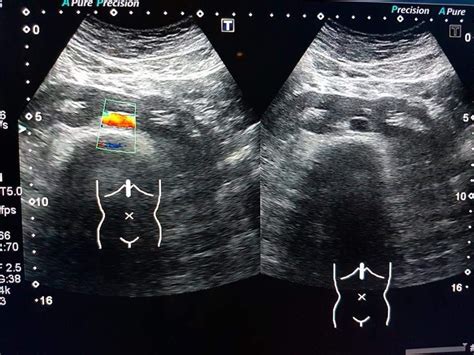 horseshoe kidney ultrasound images